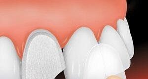 What are Dental Veneers in Dentistry?